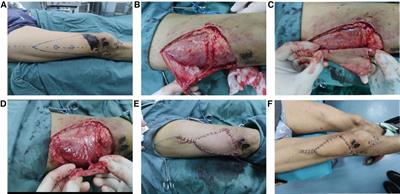 The clinical application of V-Y advanced flap pedicled with freestyle perforator flap for repairing small range defects in the anterior knee region